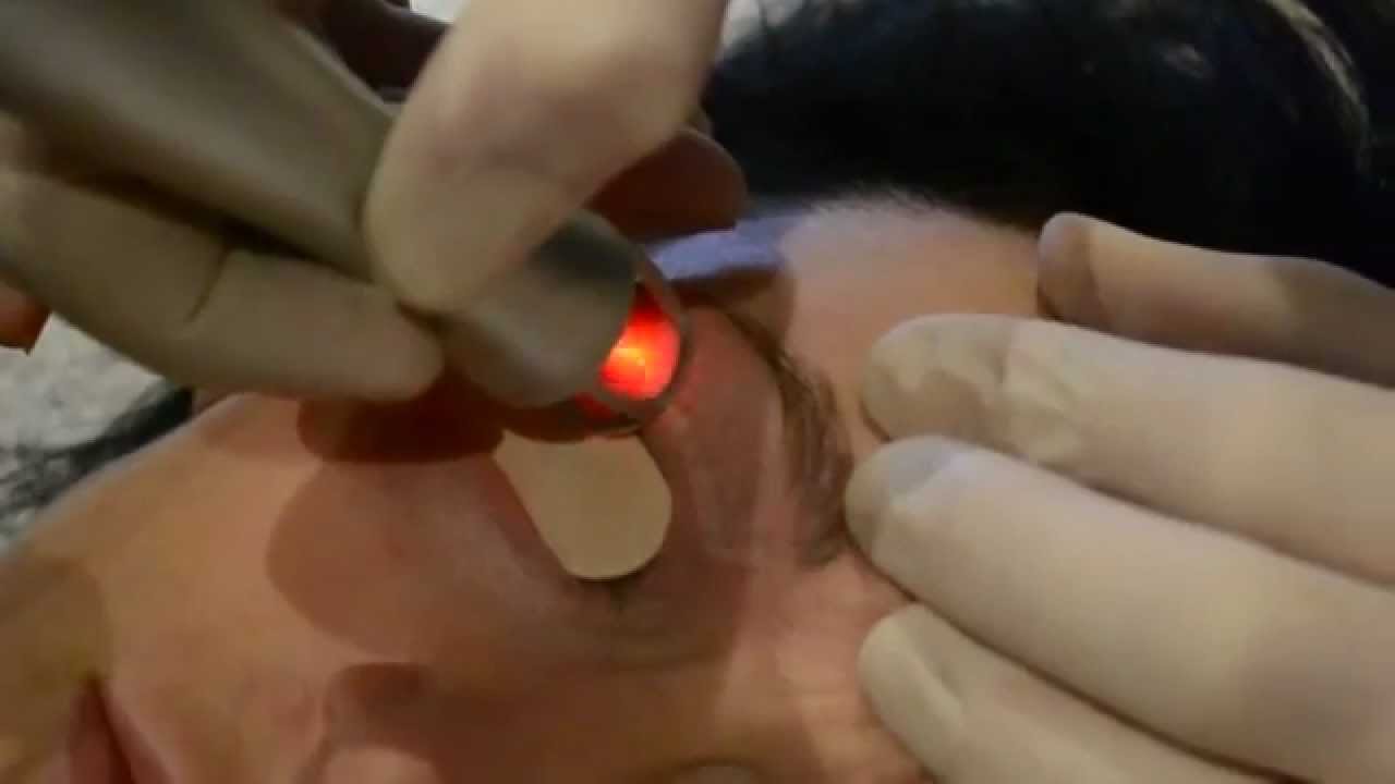 Does laser surgery help dark circles under eyes?
